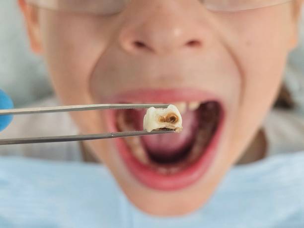 Best Emergency Root Canal Treatment in Rendon, TX